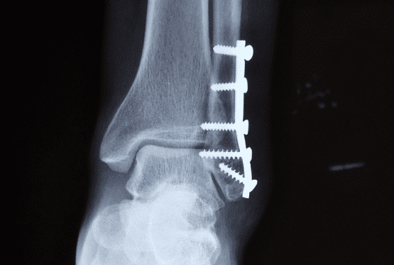 X-ray of foot | Foot and Ankle Fracture treatment by Range Foot & Ankle in Virginia & Ely, MN