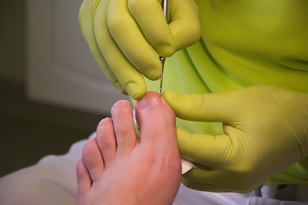Ingrown toenail treatment in Virginia & Ely, MN | Range Foot & Ankle