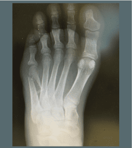 X-Ray of a broken foot taken at Range Foot & Ankle in Minnesota